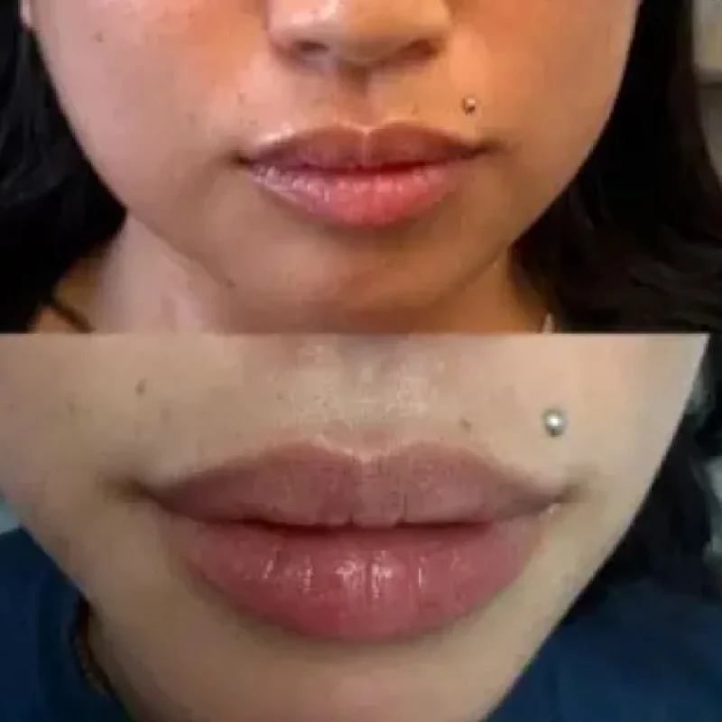 LipAugmentationwithFiller1