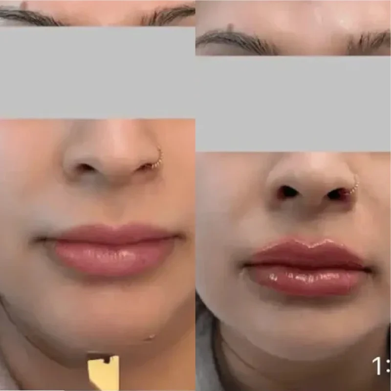 LipAugmentationwithFiller2