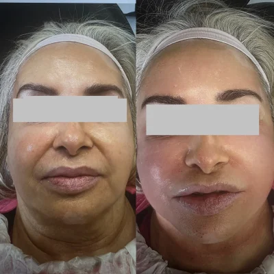 Microneedling 1