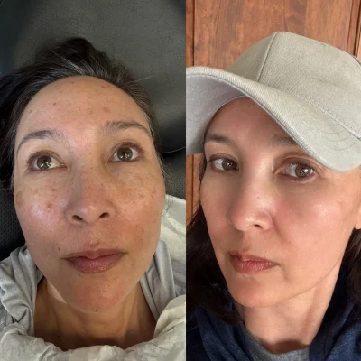 Microneedling