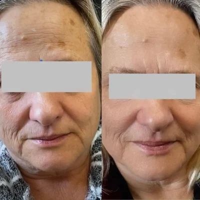 Microneedling with Exosomes