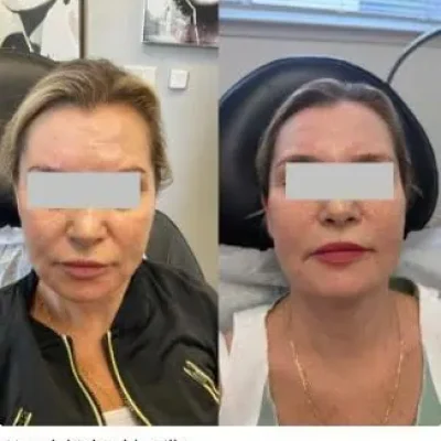 Nasolabial Folds Filler