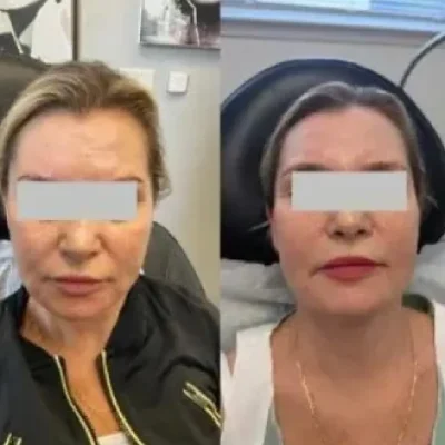 NasolabialFoldsFiller