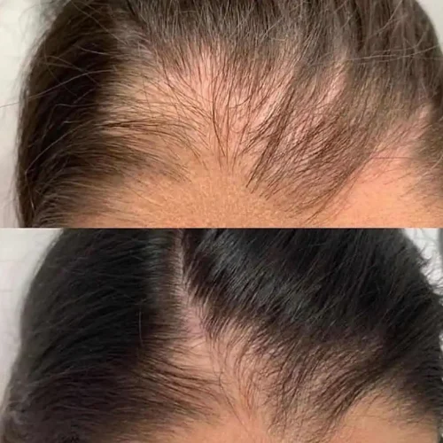 PRP for hair loss (1)