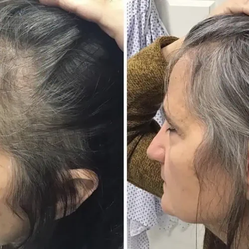 PRP for hair loss