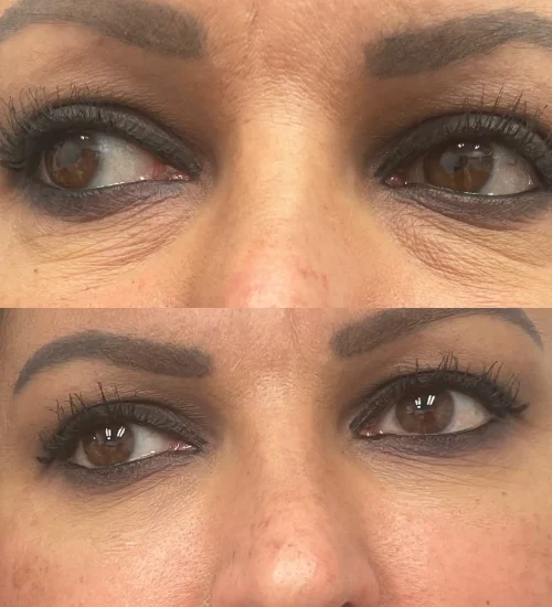 Before After d | Pink Opal Aesthetics | San Mateo, CA