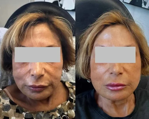 Sculptra-Before-Afters
