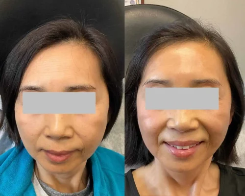 Sculptra before and after In San Mateo, CA | Pink Opal Aesthetics