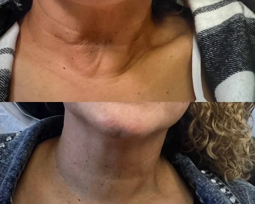 Scultpra for the Neck Before and After.