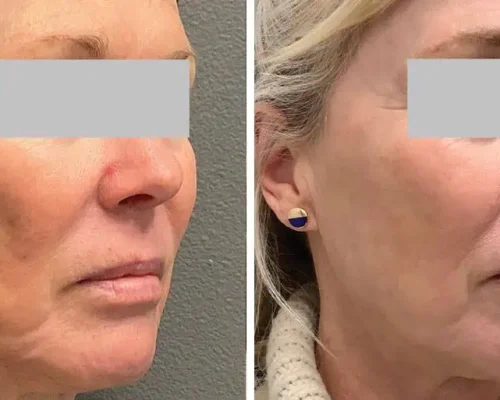 SkinVive by Juvederm