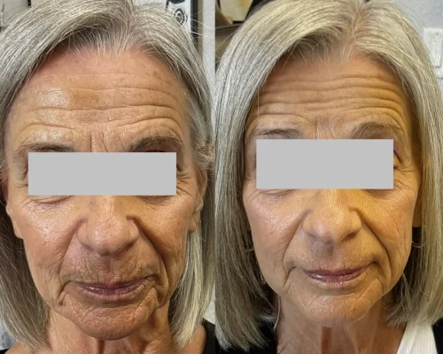 SkinVive by Juvederm Before and After in San Mateo, CA by Pink Opal Aesthetics