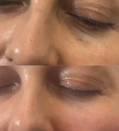 Under eye filler