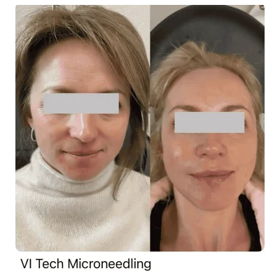 VI Tech Microneedling Before and After