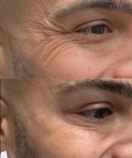 botox-before_after_pink-opal-aesthetics