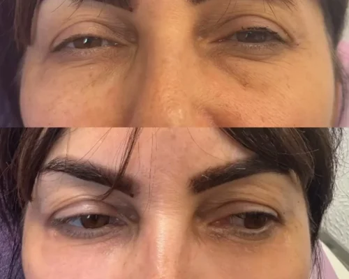 under eye filler