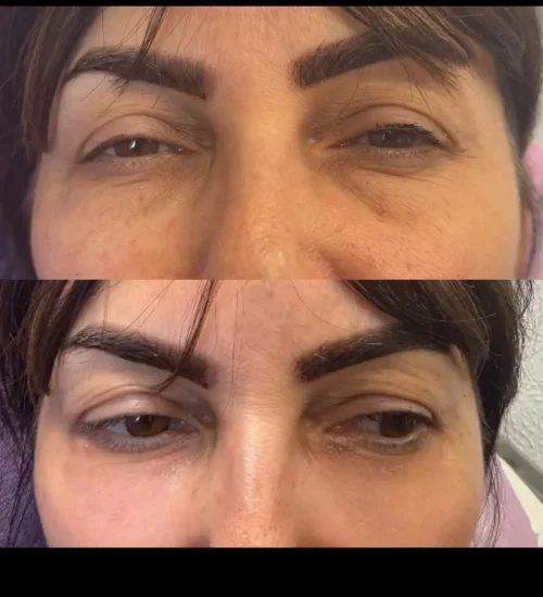 under eye filler