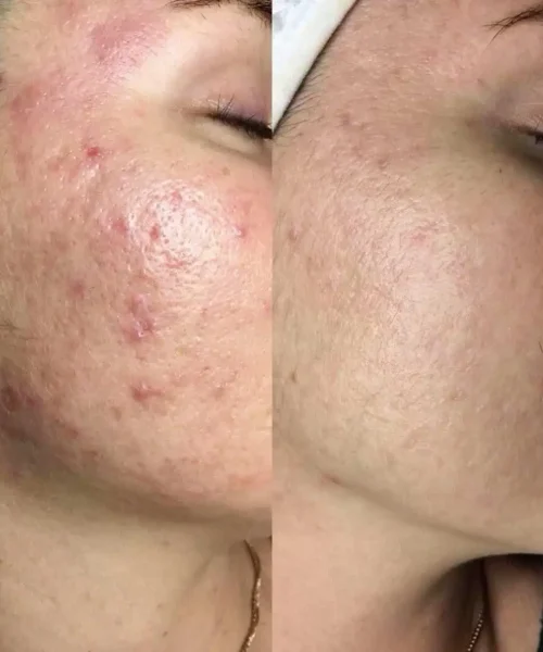 Aerolase® Neo Laser BA five