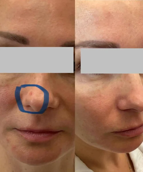 Aerolase® Neo Laser BA four