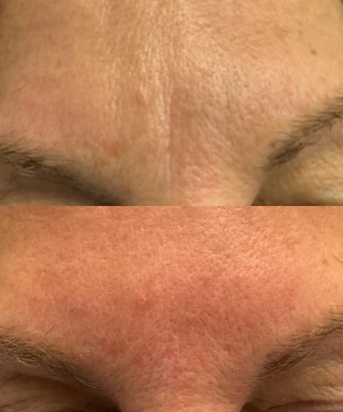Botox Treatment In San Mateo, CA | Pink Opal Aesthetics