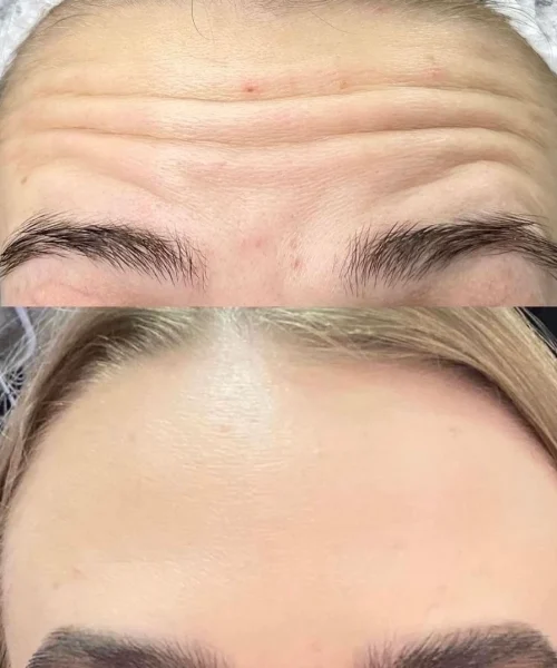 Botox Treatments In San Mateo, CA | Pink Opal Aesthetics