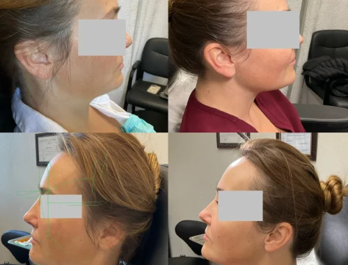 Kybella, after one session in San Mateo, CA | Pink Opal Aesthetics