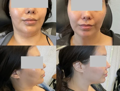 Kybella Treatment in San Mateo, CA | Pink Opal Aesthetics