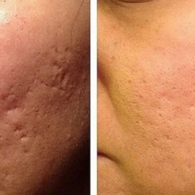 Microneedling Treatment in San Mateo, CA | Pink Opal Aesthetics