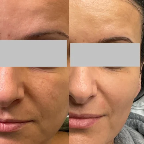 PRP Treatment In San Mateo, CA| Pink Opal Aesthetics