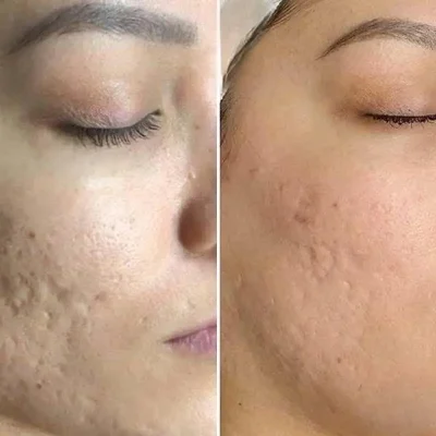 Before After b | Pink Opal Aesthetics | San Mateo, CA
