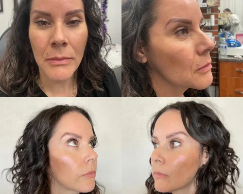 Before After c | Pink Opal Aesthetics | San Mateo, CA