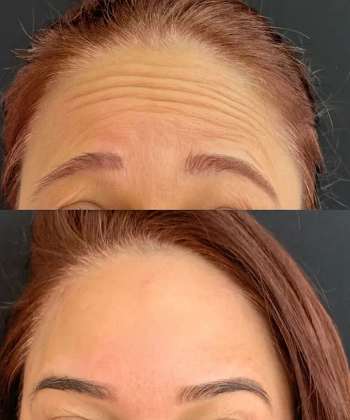 After neurotoxin a | Pink Opal Aesthetics | San Mateo, CA
