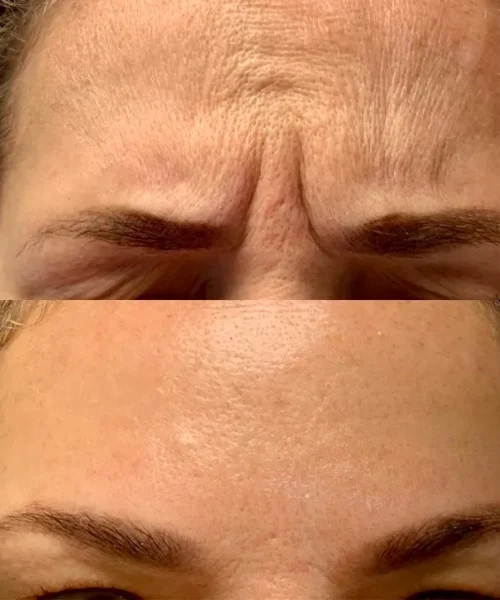 After neurotoxin b | Pink Opal Aesthetics | San Mateo, CA