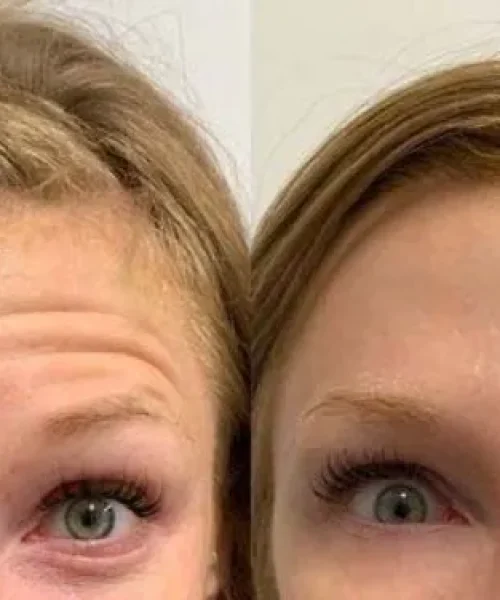 Before After neurotoxin c | Pink Opal Aesthetics | San Mateo, CA