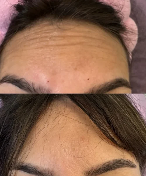 Before After neurotoxin d | Pink Opal Aesthetics | San Mateo, CA