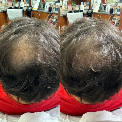 Before After prp a | Pink Opal Aesthetics | San Mateo, CA