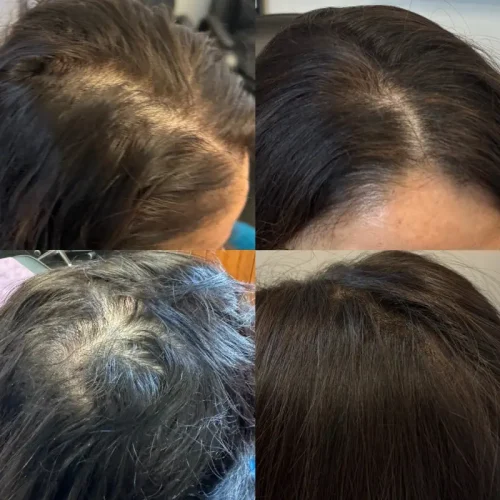 Before After prp b | Pink Opal Aesthetics | San Mateo, CA