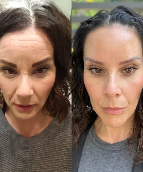 Before After q| Pink Opal Aesthetics | San Mateo, CA