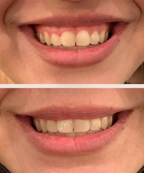 Before After w | Pink Opal Aesthetics | San Mateo, CA
