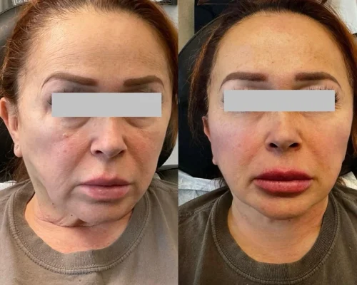 Gallery Facial Balancing | Pink Opal Aesthetics | San Mateo, CA
