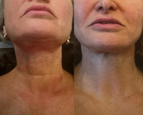 Gallery Sculptra | Pink Opal Aesthetics | San Mateo, CA