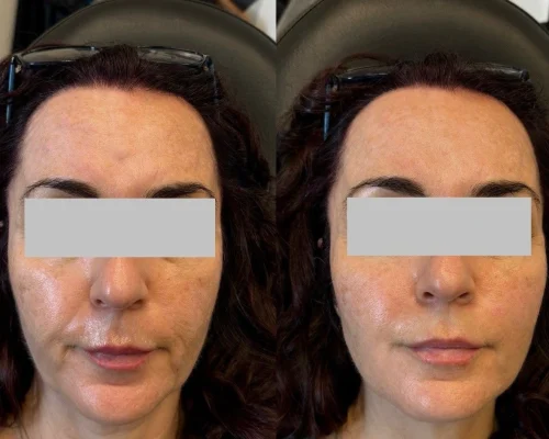 Aesthetics Gallery Transformation | Pink Opal Aesthetics | San Mateo, CA
