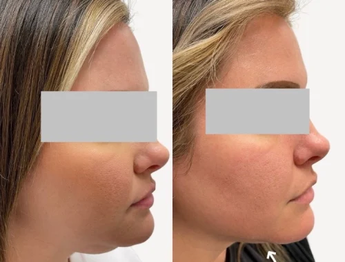 Kybella for Submental Fat Before After A | Pink Opal Aesthetics | San Mateo, CA