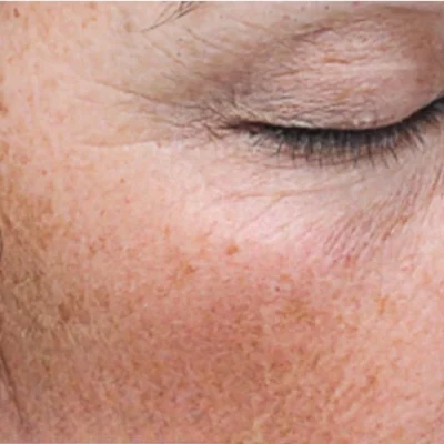 Microneedling Before After A | Pink Opal Aesthetics | San Mateo, CA