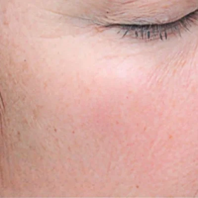 Microneedling Before After B | Pink Opal Aesthetics | San Mateo, CA