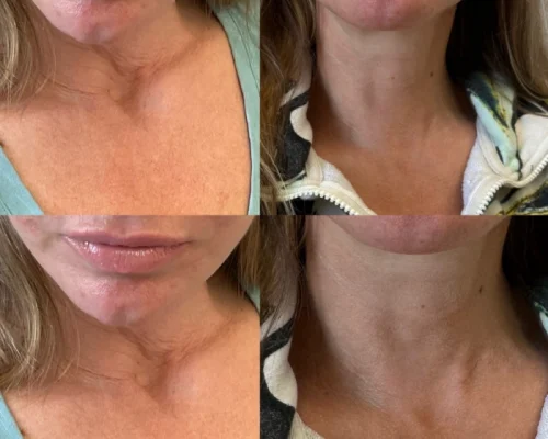 Sculptra Before After A | Pink Opal Aesthetics | San Mateo, CA