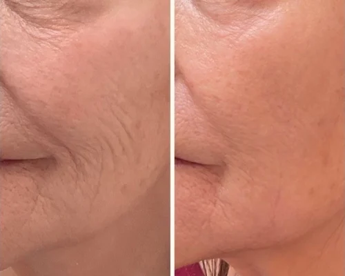 Skinvive by Juvederm Before After A | Pink Opal Aesthetics | San Mateo, CA
