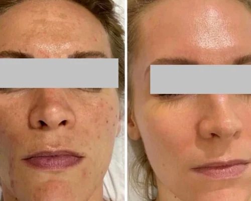 chemical peel Before After A | Pink Opal Aesthetics | San Mateo, CA