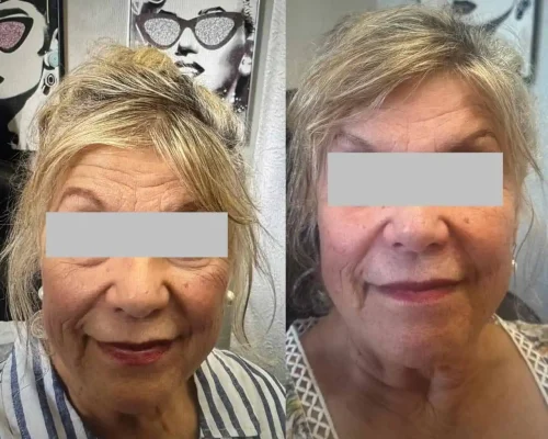 Sculptra Before After 1 in San Mateo CA