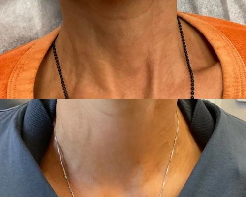 Sculptra before and after In San Mateo, CA | Pink Opal Aesthetics