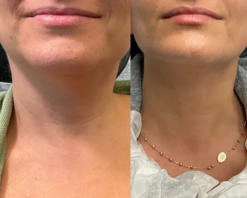 Sculptra Treatment In San Mateo, CA | Pink Opal Aesthetics